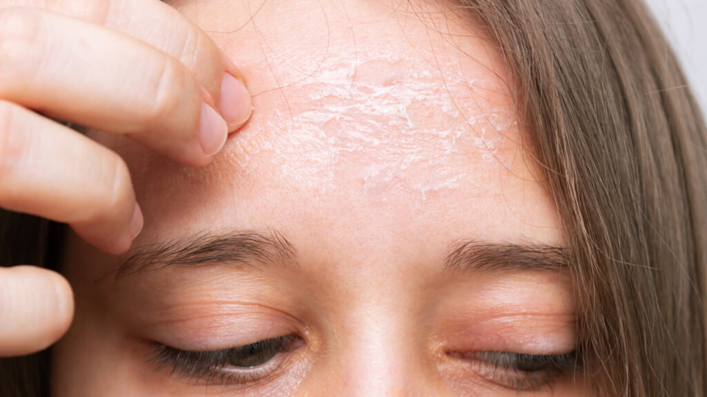 perils of dehydrated skin